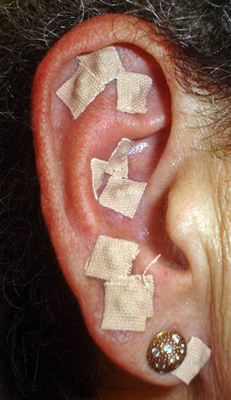 Técnicas de acupuntura na orelha