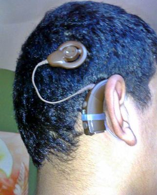 Implante de aparelho auditivo coclear