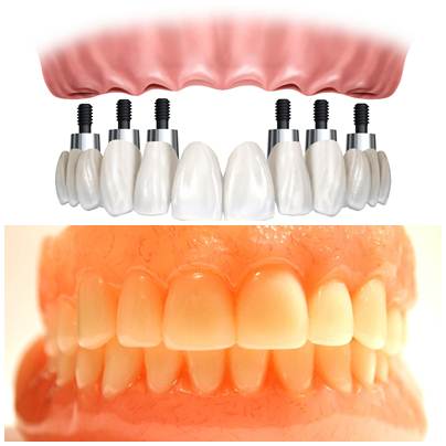 Dois tipos de prótese odontológica