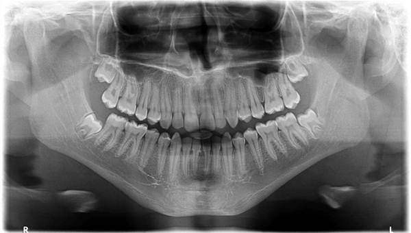 Raio-x da mandibula